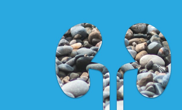 kidney stones (1)_final copy__1452056070_182.73.28.50