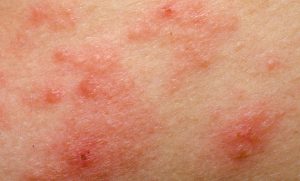 atopic dermatitis is most common type of skin rash