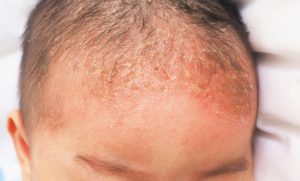 seborrheic dermatitis 