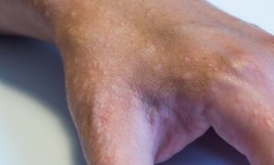dyshidrotic dermatitis is a type of eczema
