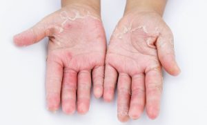 contact dermatitis is common type of skin rash