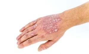 psoriasis common skin disease that affects joints, scalp and other parts of the body