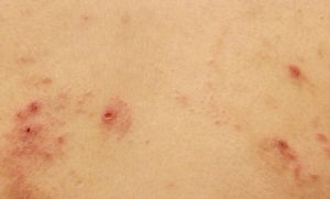 Dermatitis Medicamentosa (Drug eruptions)