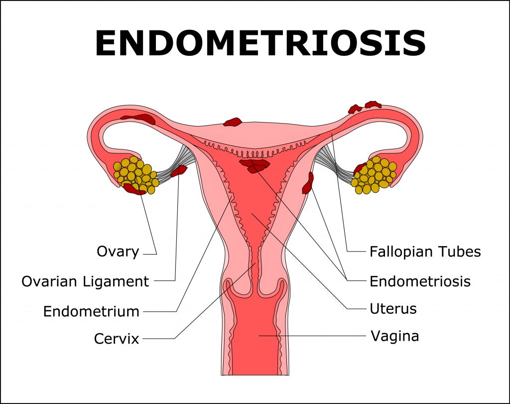 endometriosis can cause back pain