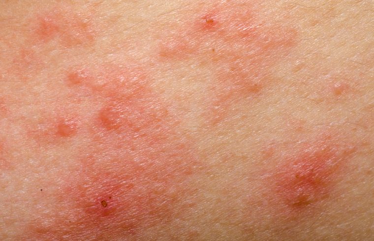 Different types of skin rashes