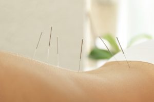 acupuncture to treat back pain