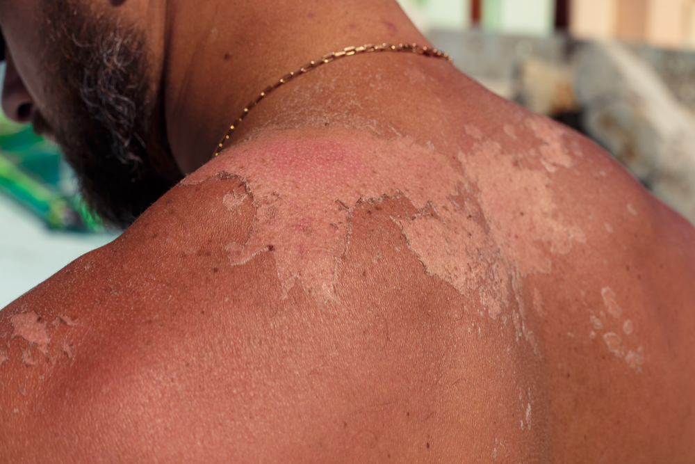 sunburn blisters treatment at home