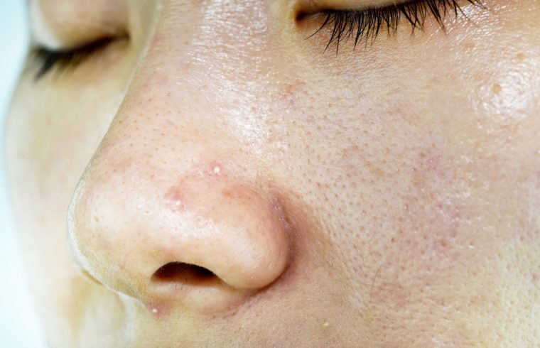 Home remedies for whiteheads in hindi