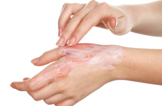 Home remedies for burns