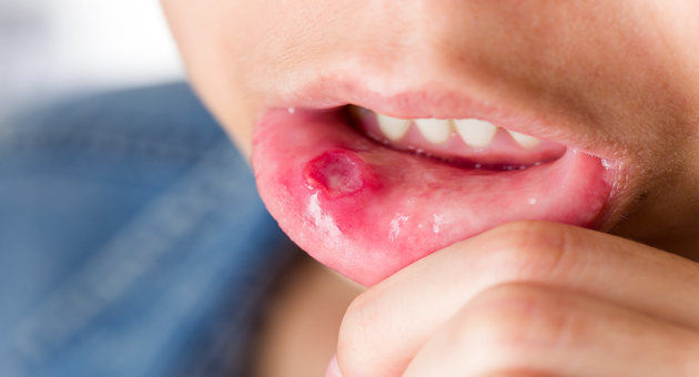 painful mouth ulcers