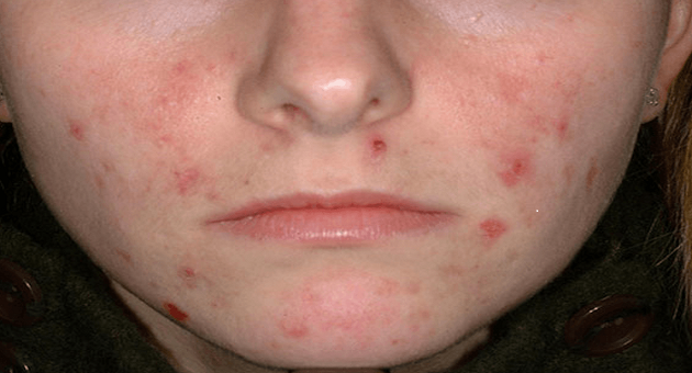 Acne: Causes,Treatment Options And Personal Care