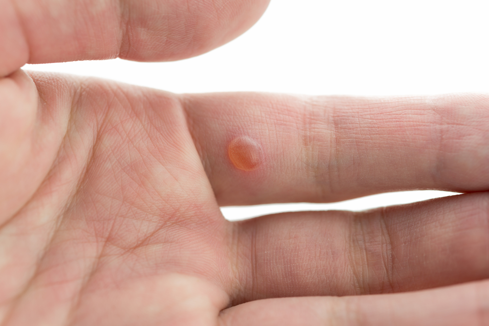 Worrisome Warts Try These 7 Home Remedies To Get Rid Of Them Tata 1mg Capsules - Diy Wart Removal On Arm