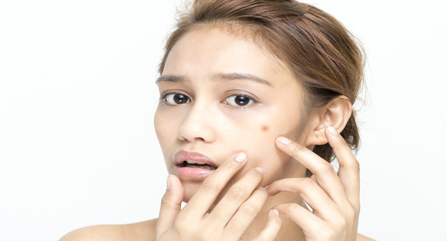 Do You Get Acne Too Often? 5 Tips For You To Try This Summer Season!