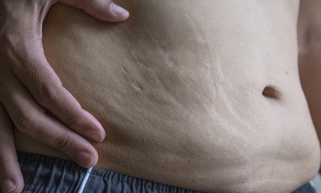 Home Remedies For Stretch Marks