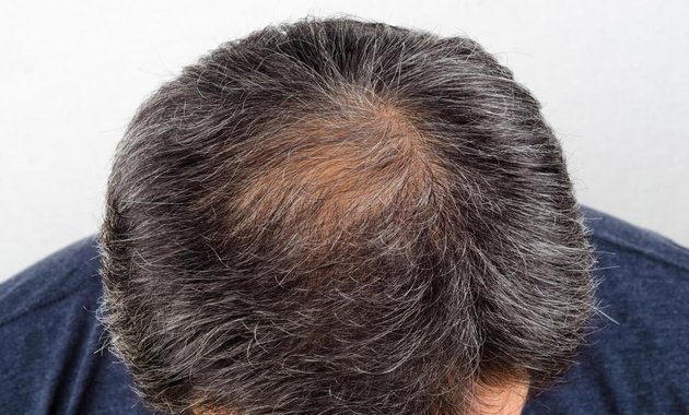 1mg News Digest: Early Balding and Grey Hair Linked to Heart Disease in Men  - Tata 1mg Capsules