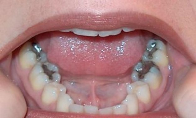 Are Your Silver Fillings Toxic To Your Body?