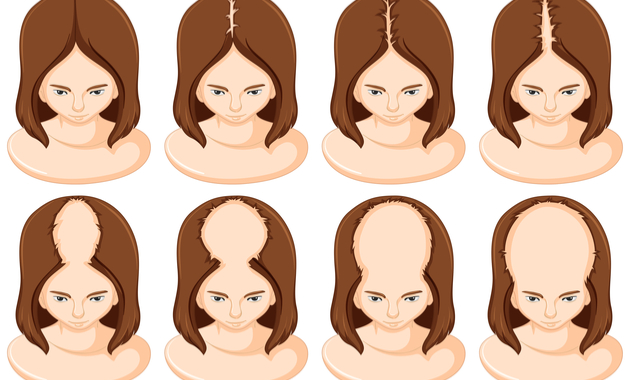female pattern baldness
