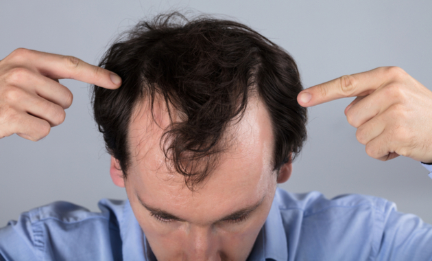 Hair loss treatment Medicines for hair fall and hair regrowth  Times of  India