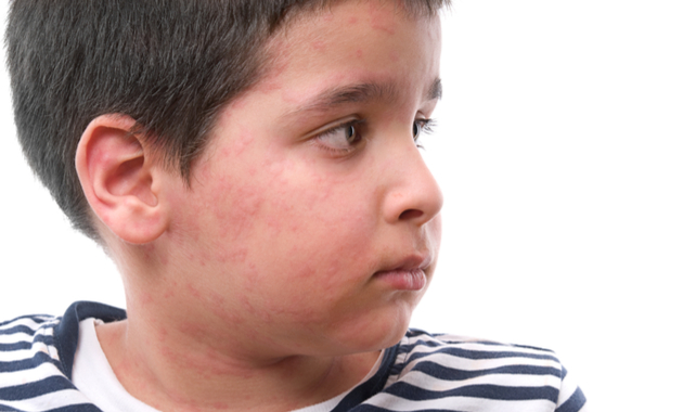 skin allergy in kids