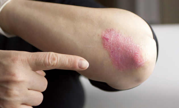 Psoriasis