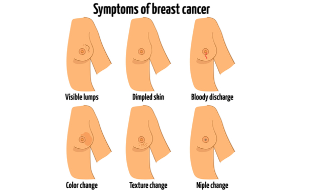 signs and symptoms of breast cancer