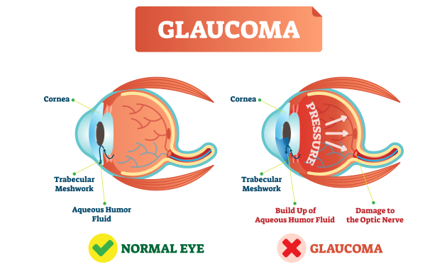 glaucoma