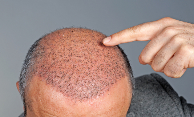 Hair Transplant Insurance