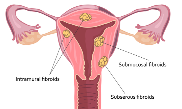 uterine fibroids