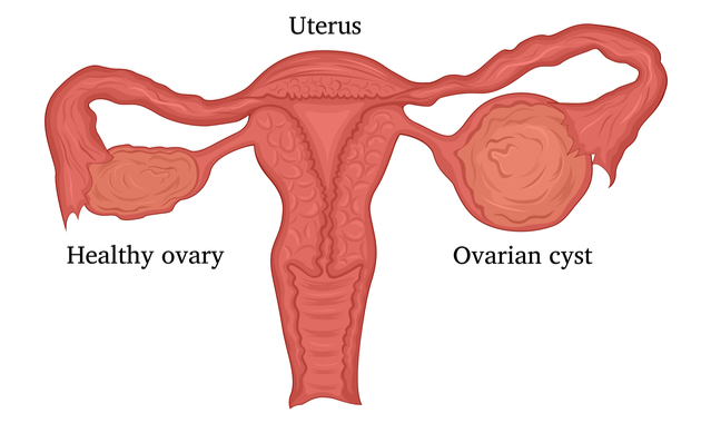 Ovarian cysts