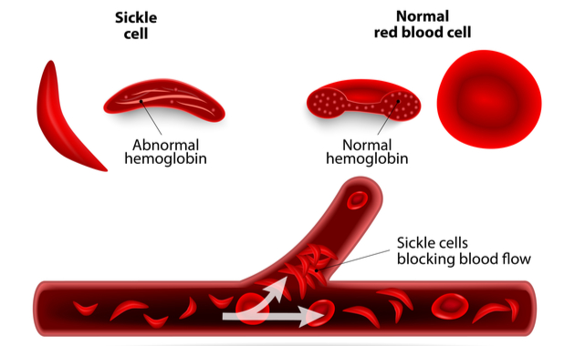 sickle cell anemia