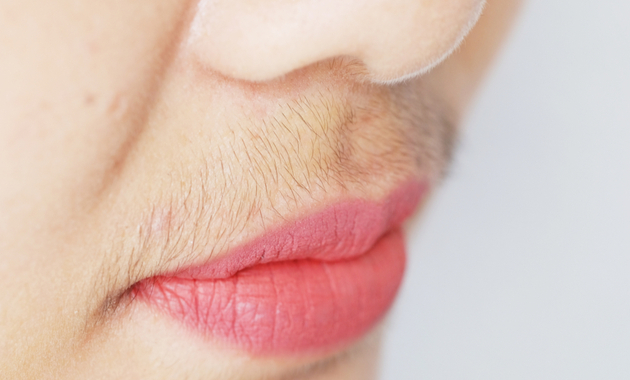 Hirsutism causes and management