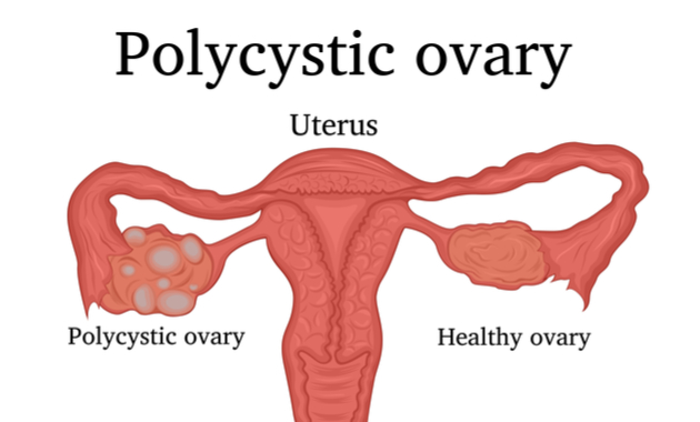 pcos