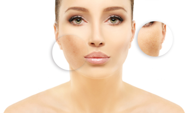 melasma care