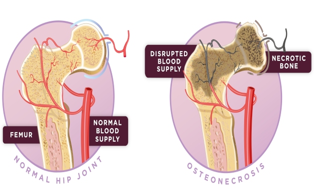 Hip pain - Avasular necrosis