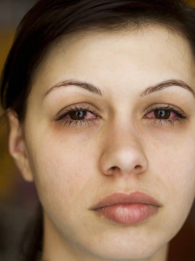 Monsoon Eye Flu Alert: Top 6 Prevention Tips Monsoon Eye Flu Alert: Top 6 Prevention Tips