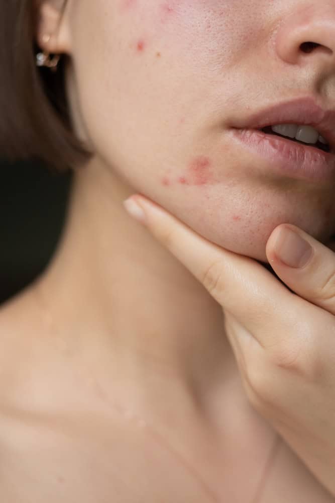 allergic reaction to glutathione Skin Lightening? 4 Hidden Dangers Of Glutathione Injections