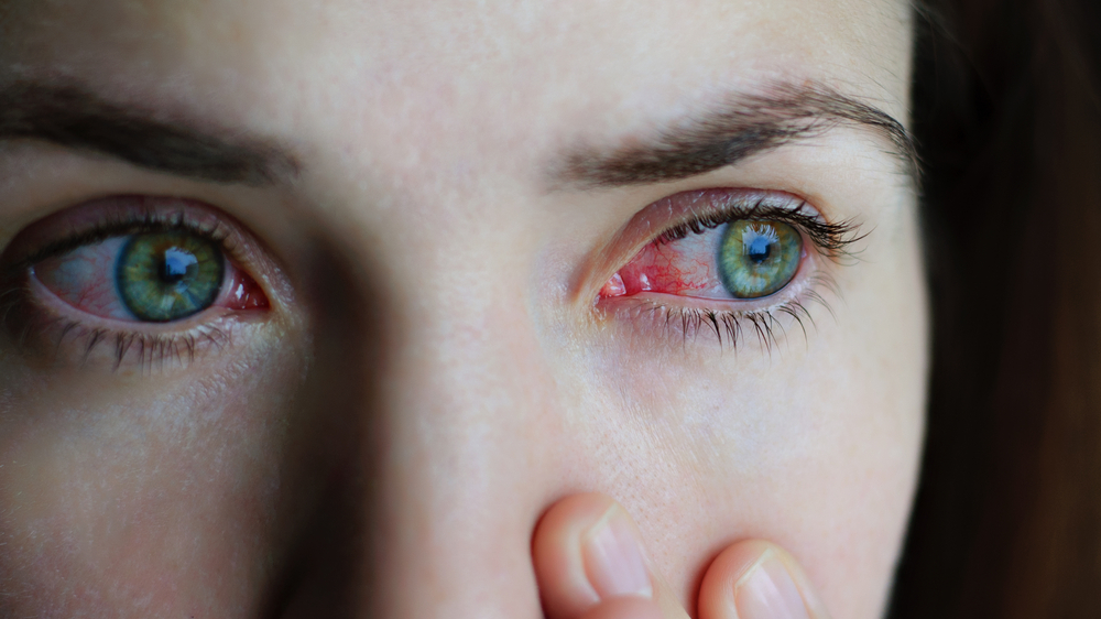 Eye Flu or Conjunctivitis