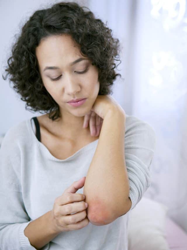 Psoriasis? Add These 5 Foods To Your Diet Today Psoriasis? Add These 5 Foods To Your Diet Today