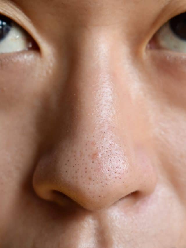 5 Tips To Remove Blackheads
