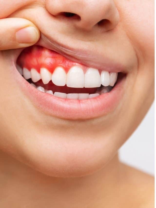 5 Effective Home Remedies For Bleeding Gums 5 Effective Home Remedies For Bleeding Gums