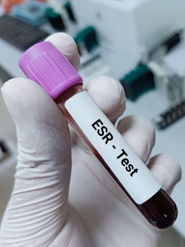 Understanding High ESR Levels What You Need to Know Tata 1mg Capsules