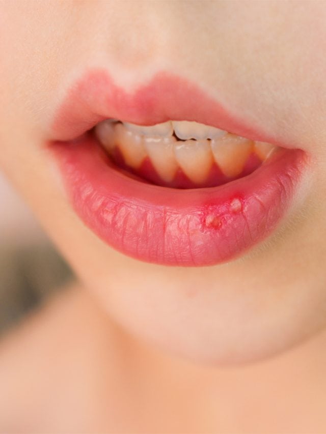 5 Common Reasons Of Mouth Ulcers 5 Common Reasons Of Mouth Ulcers