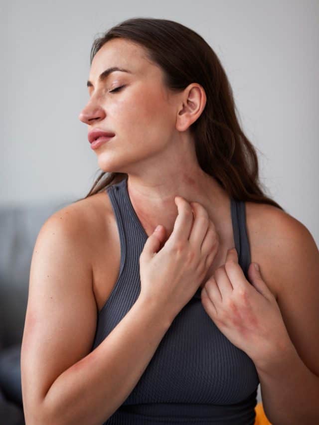 5 Ways To Alleviate Cold Rashes Naturally