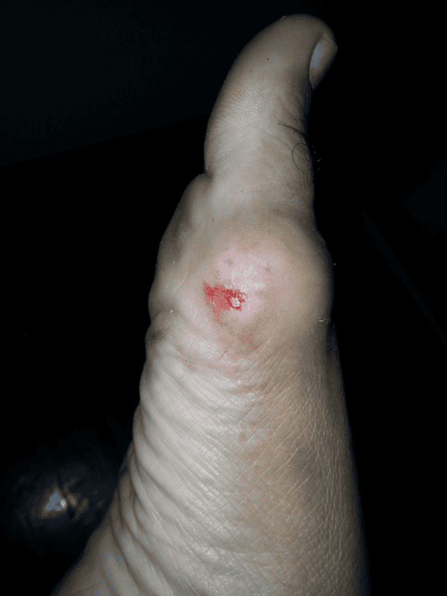 Diabetic Foot Ulcers: Add These 4 Foods In Your Diet