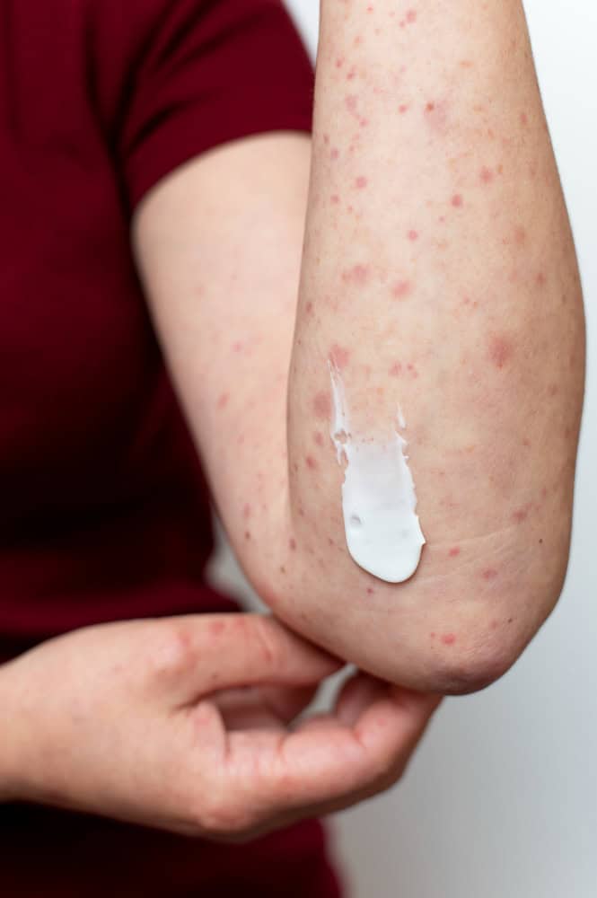5 Signs Of Atopic Dermatitis You Shouldn't Ignore - Tata 1mg Capsules