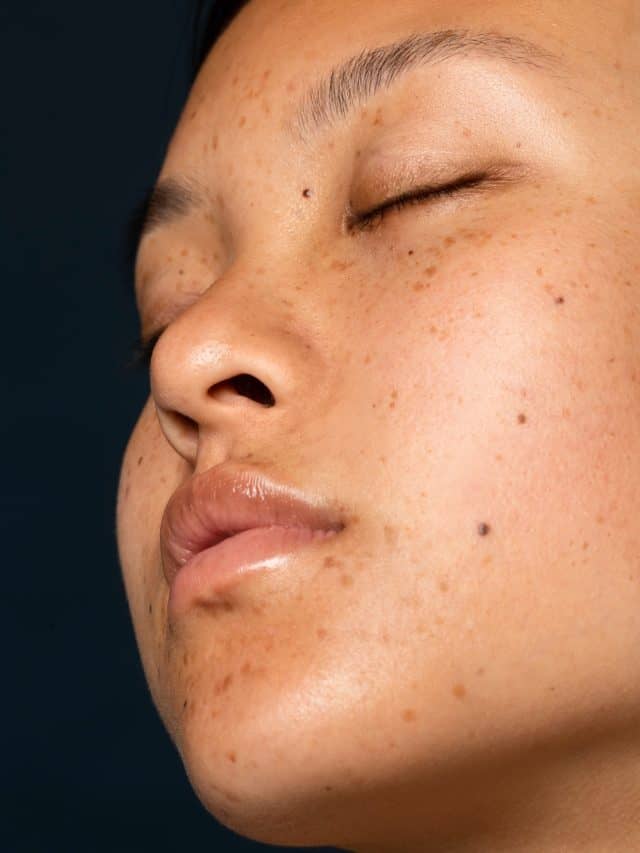 Why Does Pigmentation Appear On The Face?