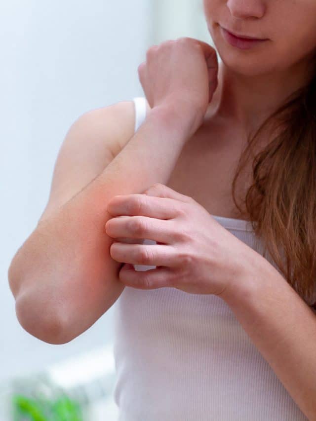 Simple Remedies For Summer Heat Rashes Simple Remedies For Summer Heat Rashes