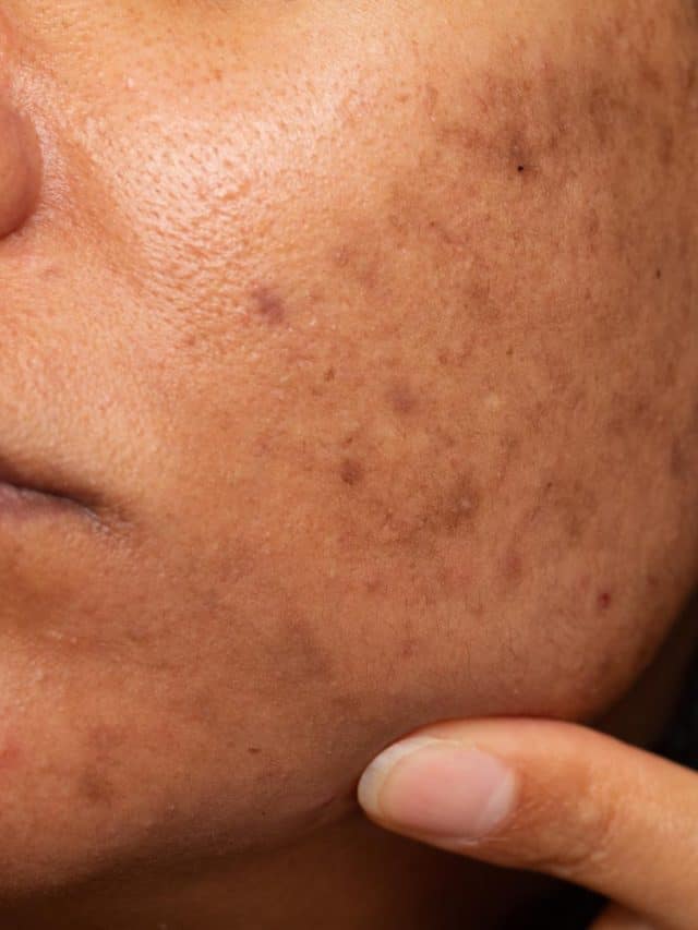 5 Home Remedies For Skin Pigmentation