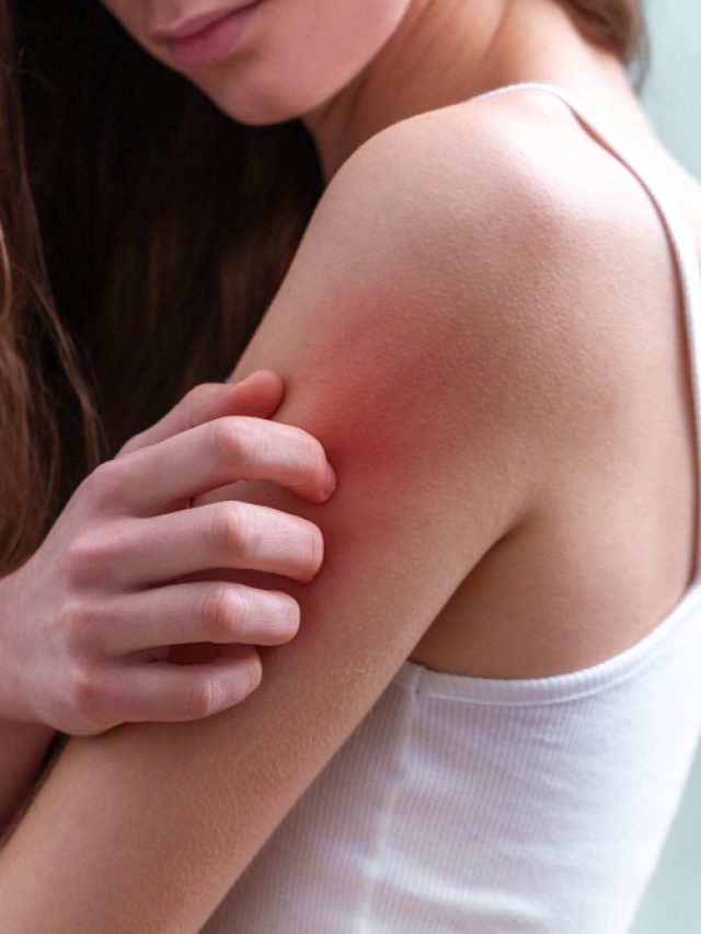 7 Effective Home Remedies For Prickly Heat 7 Effective Home Remedies For Prickly Heat