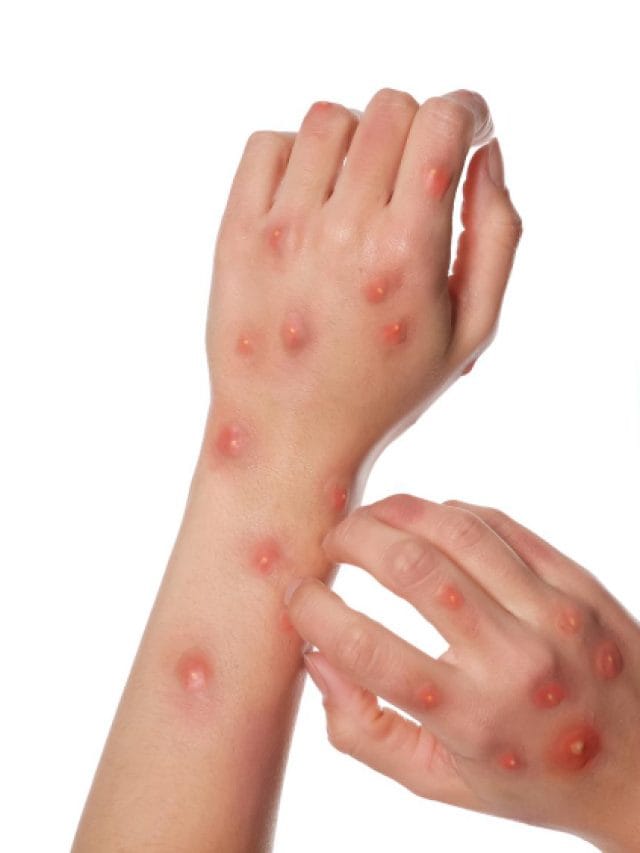 Mpox Outbreak: AIIMS Delhi’s Latest Treatment Guidelines Mpox Outbreak: AIIMS Delhi’s Latest Treatment Guidelines